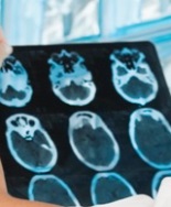 Parkinson a esordio precoce: temperatura cerebrale potrebbe essere bersaglio terapeutico